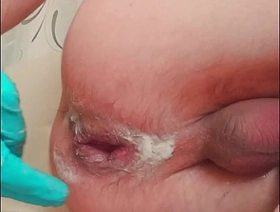 handsome skinny twink with ruptured prolapse makes fisting to himself japan gay gangbang porn